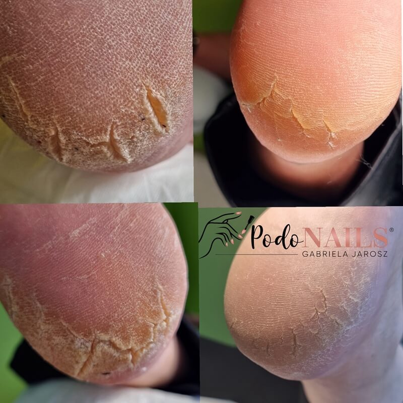 Pękające pięty i zrogowacenia — PodoNAILS Podologia