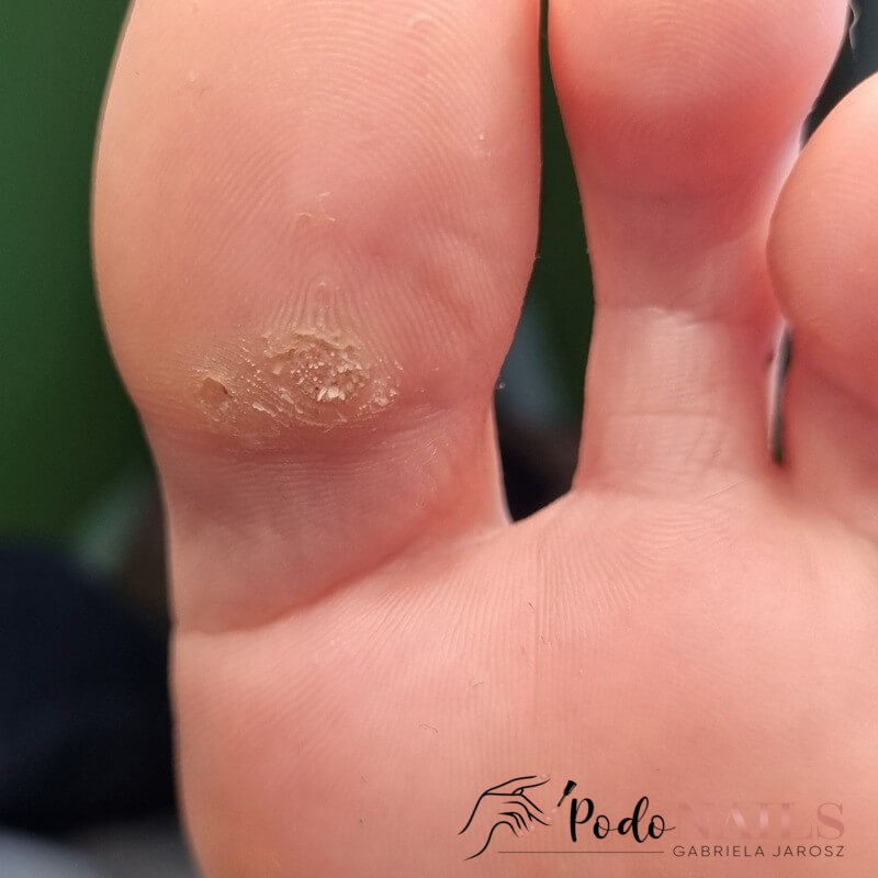 Kurzajki i brodawki wirusowe — PodoNAILS Podologia