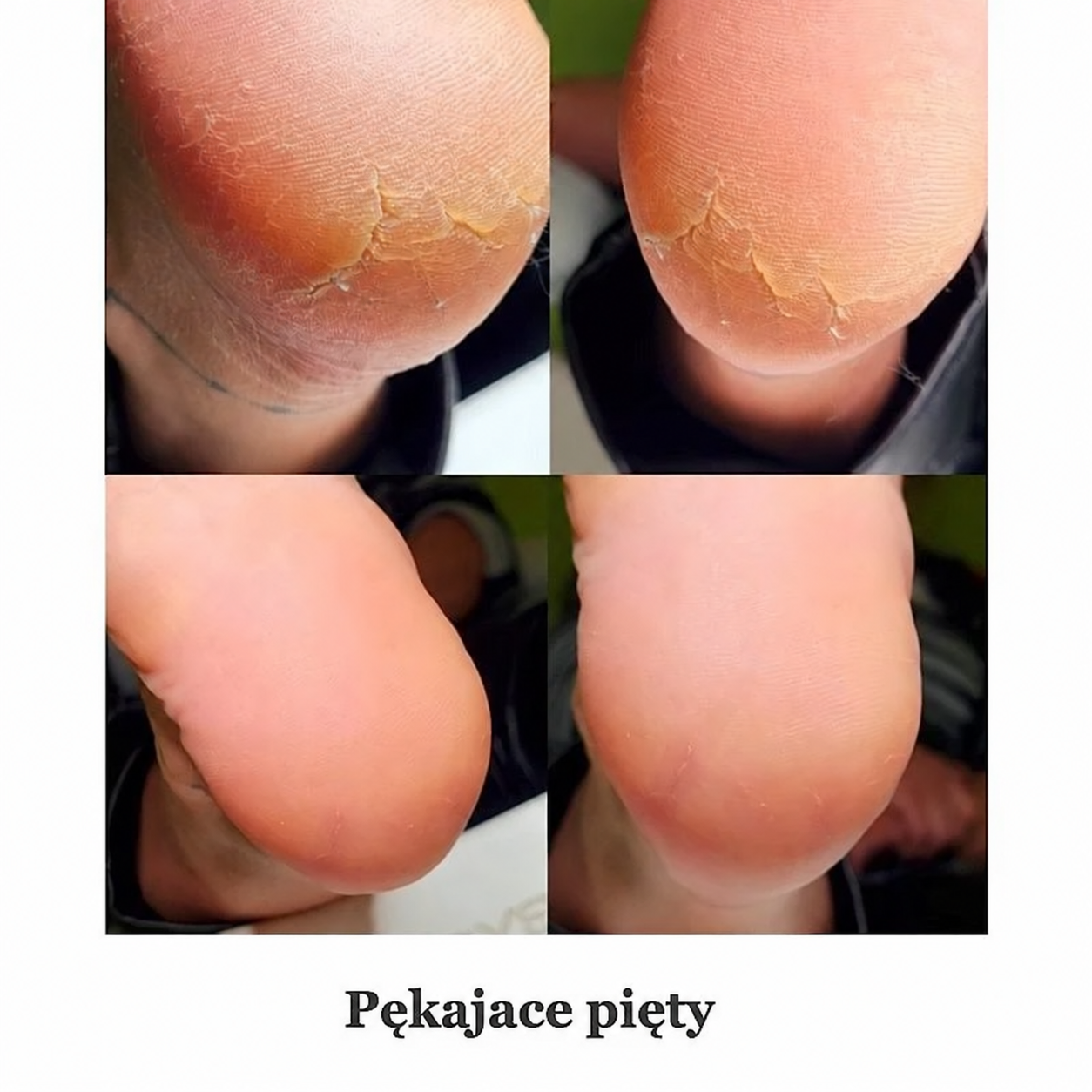 Pękające pięty — jak uporządkować pielęgnację? — poradnik PodoNAILS