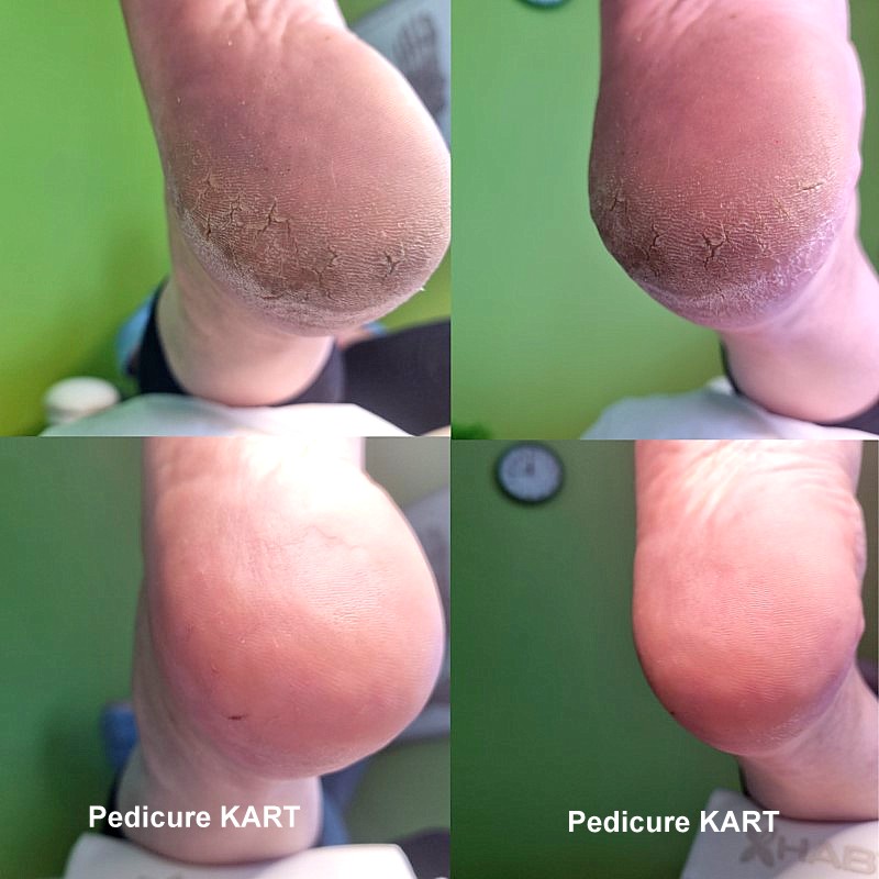 Podologiczny pedicure KART — PodoNAILS Podologia