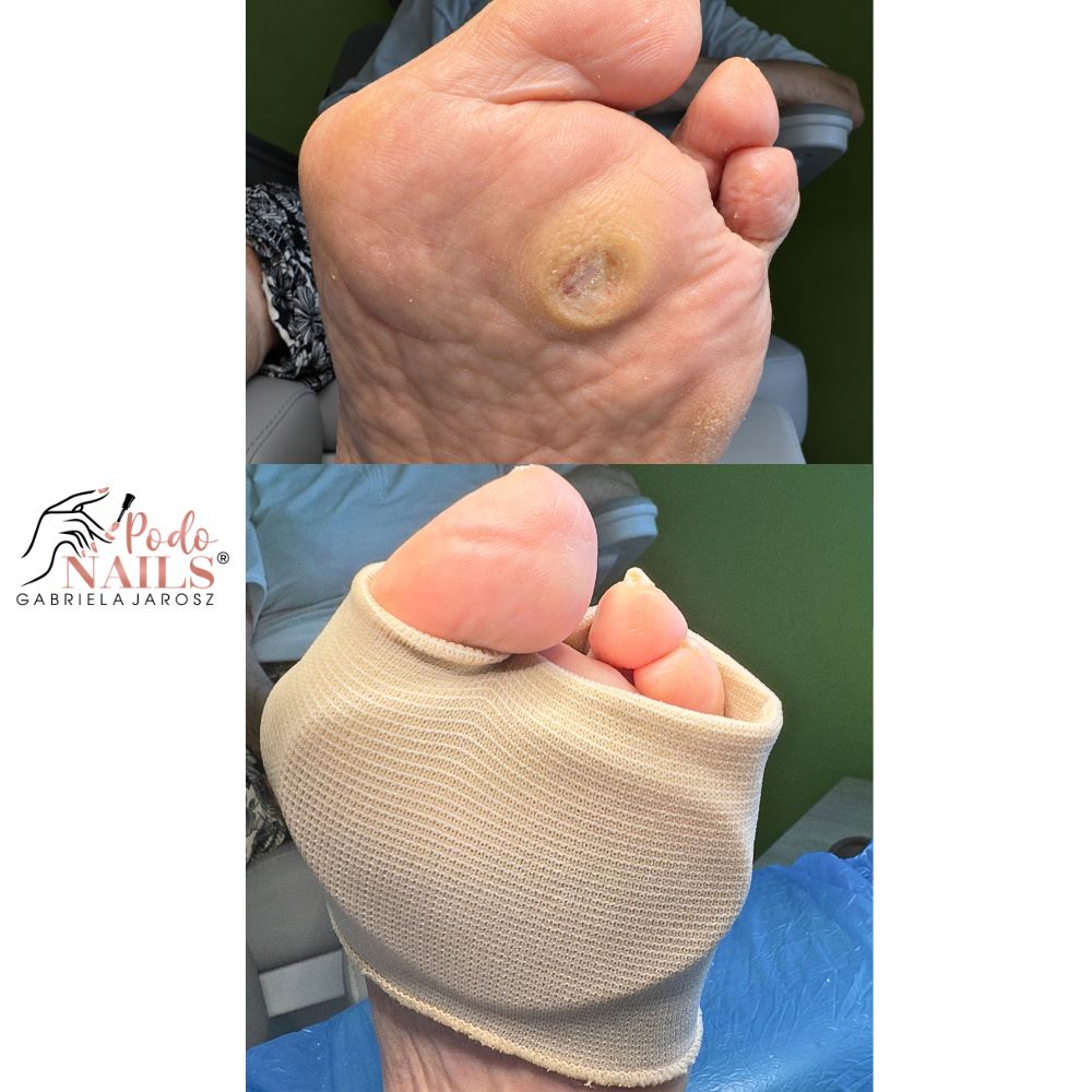 Dobór ortez i odciążeń — PodoNAILS Podologia