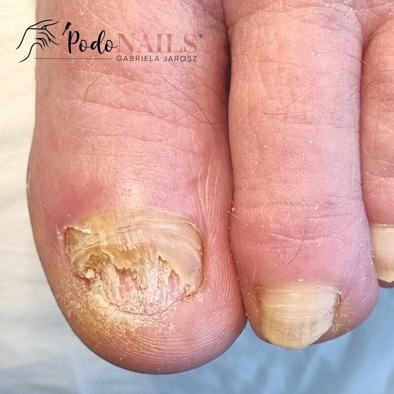 Wsparcie przy grzybicy paznokci i stóp — PodoNAILS Podologia