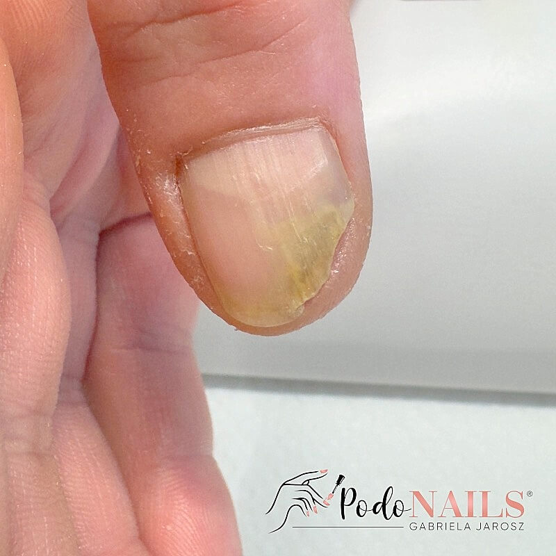 Onycholiza i zmiany paznokci — PodoNAILS Podologia